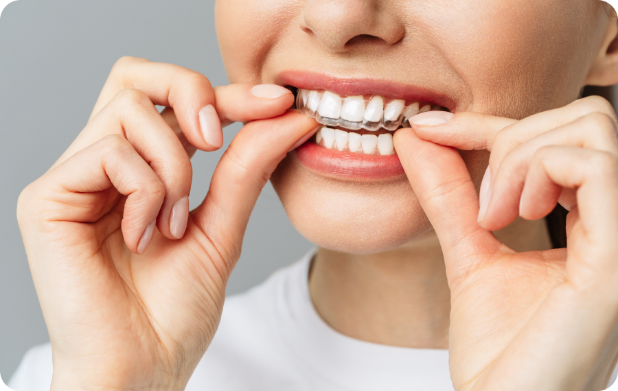 gouttiere-sourire-montigny